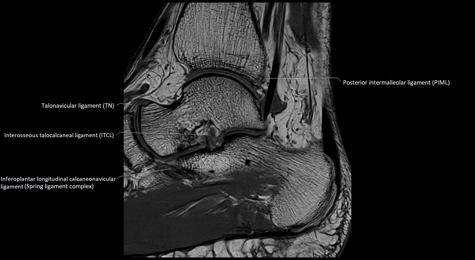 MRI ankle ligaments anatomy sagittal 3T image 12.webp